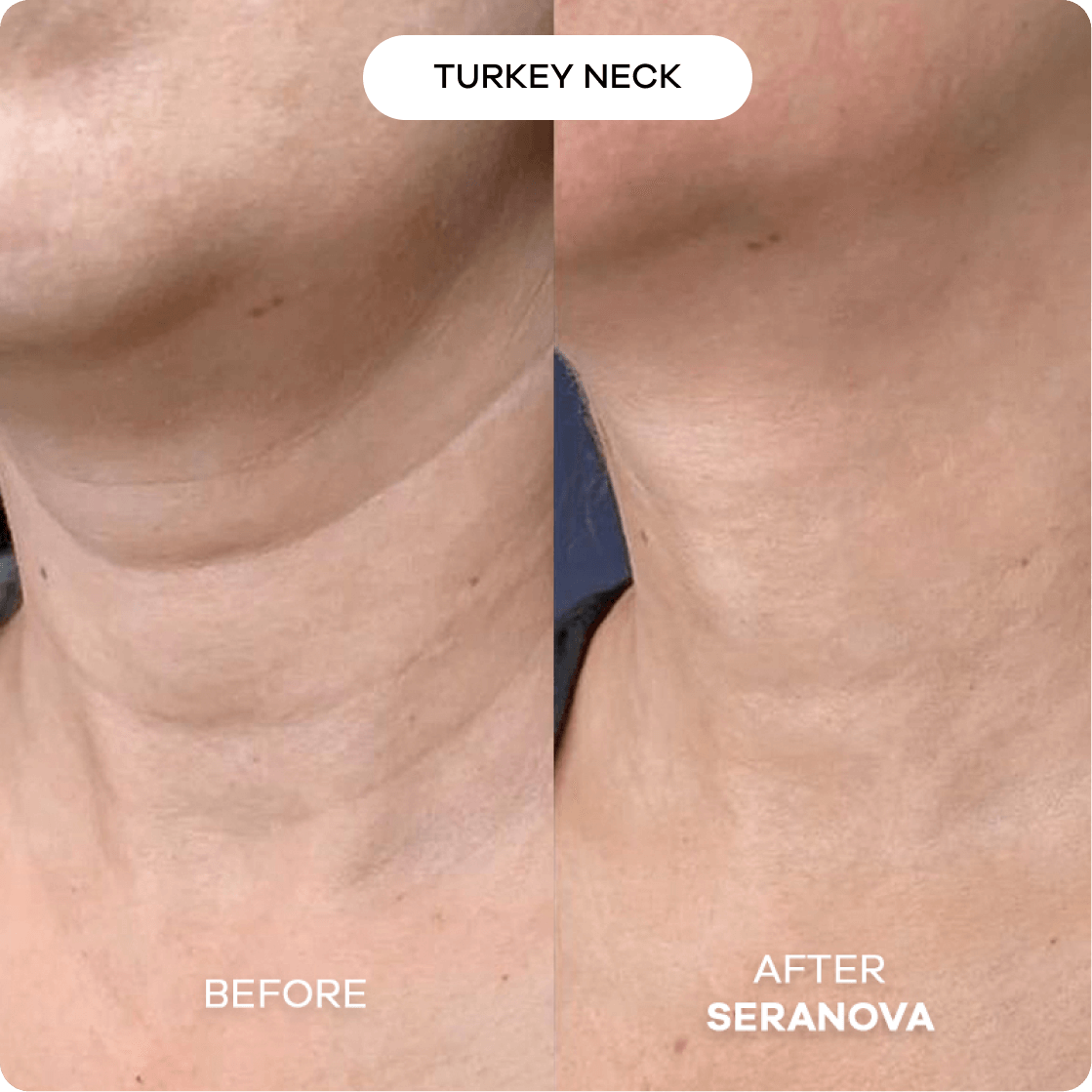 6 - Month Supply of The Microneedling Infusion System™ - Seranova