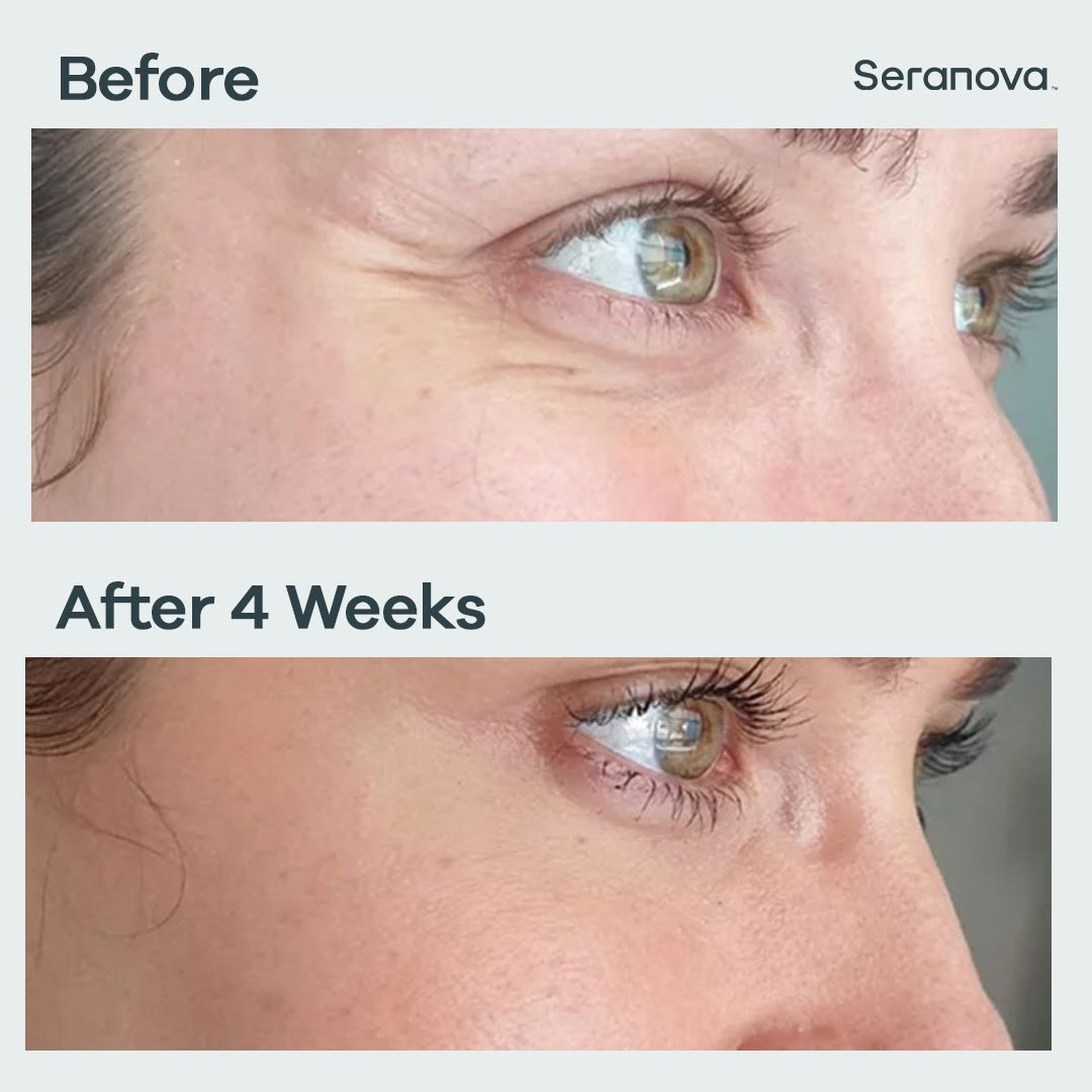 Micro Infusion Patches - Seranova