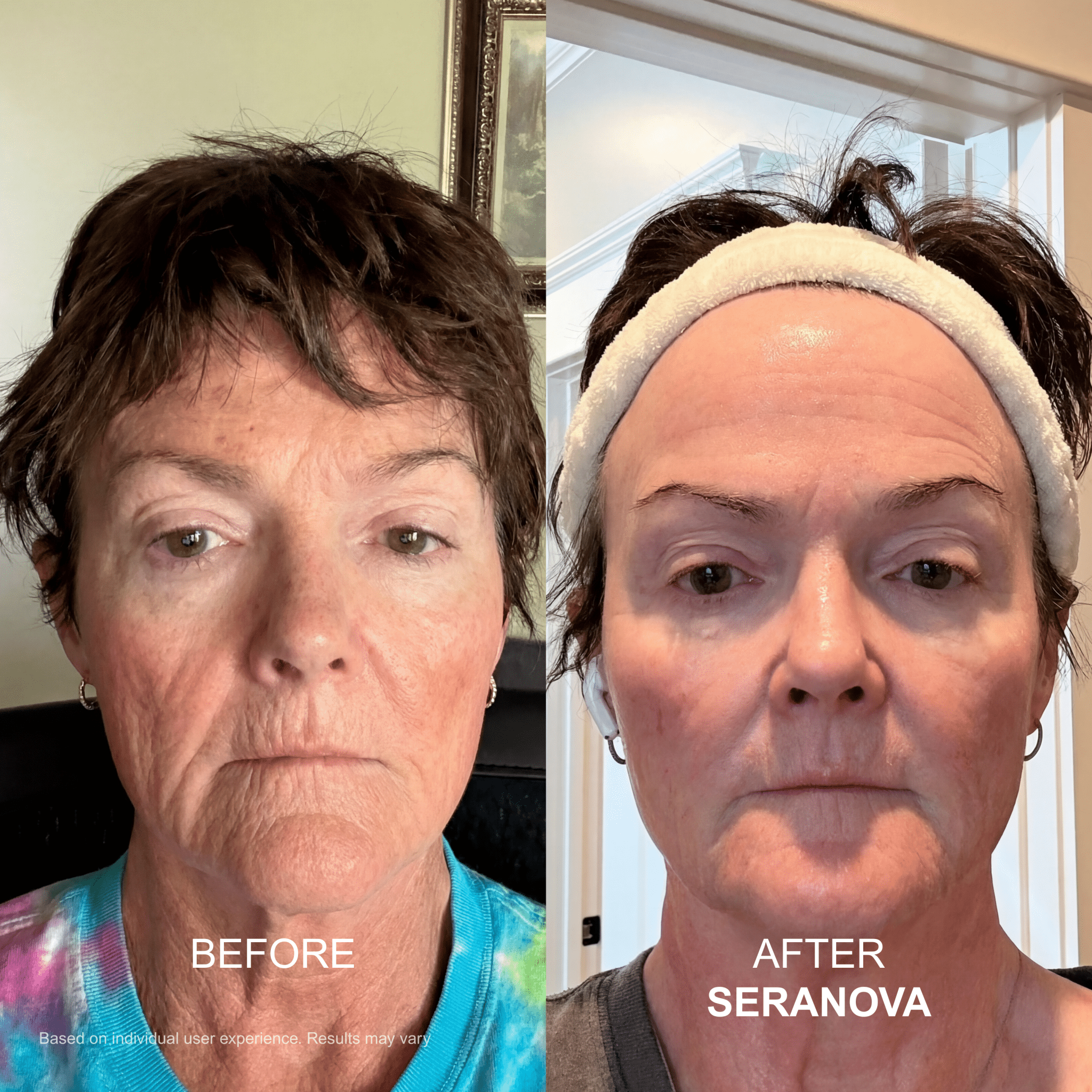 The Micro Infusion System™ - Seranova