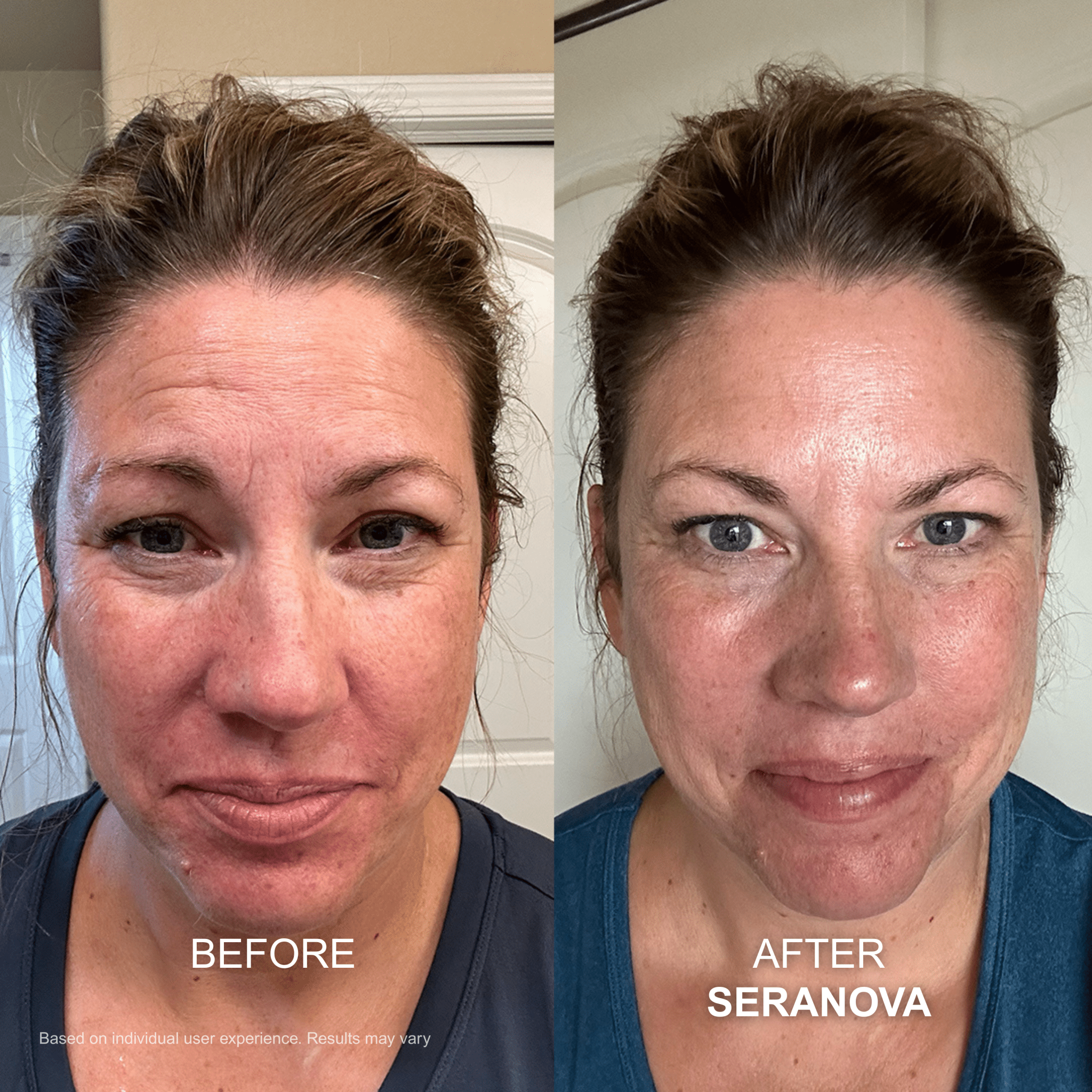 The Micro Infusion System™ - Seranova