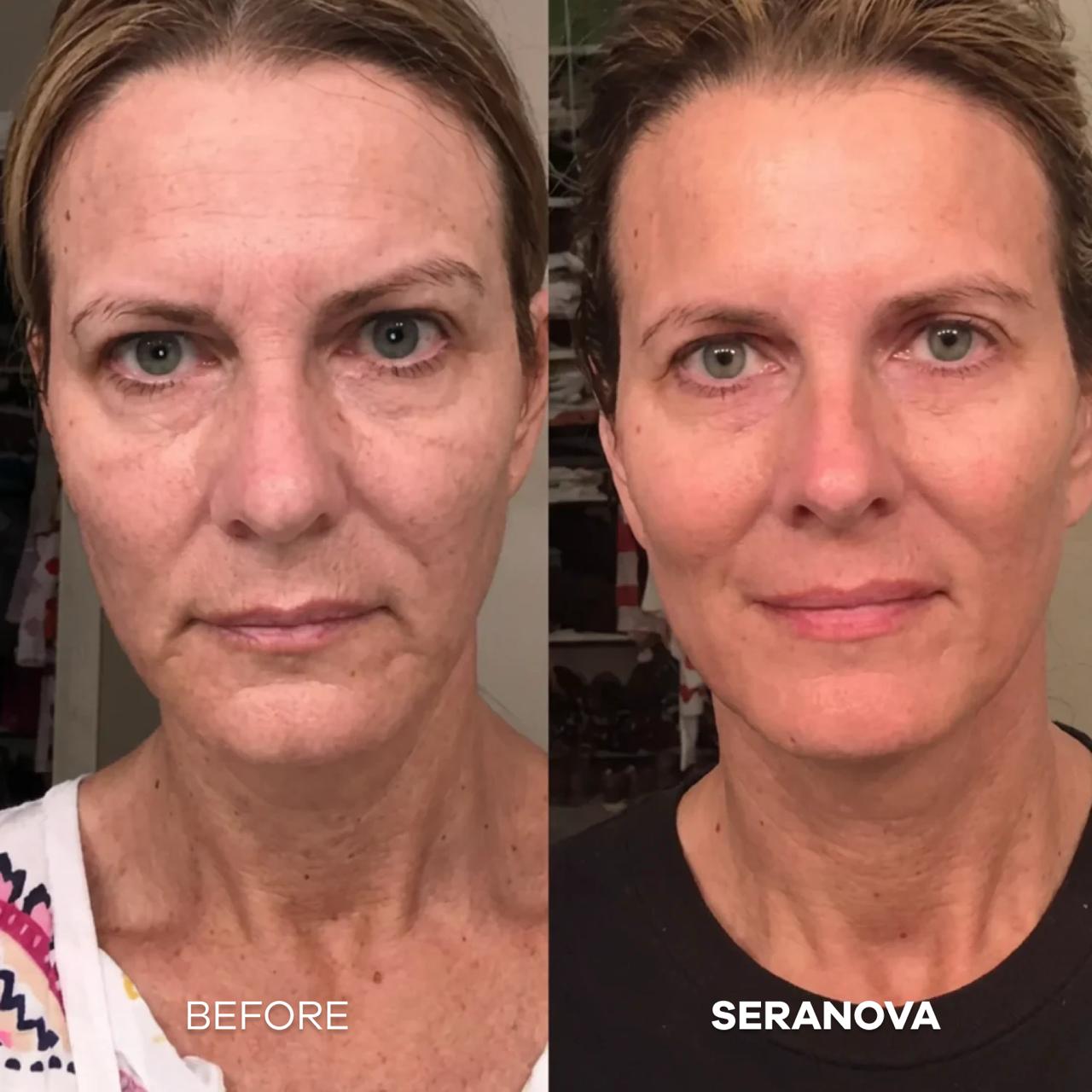 The Micro Infusion System™ - Seranova