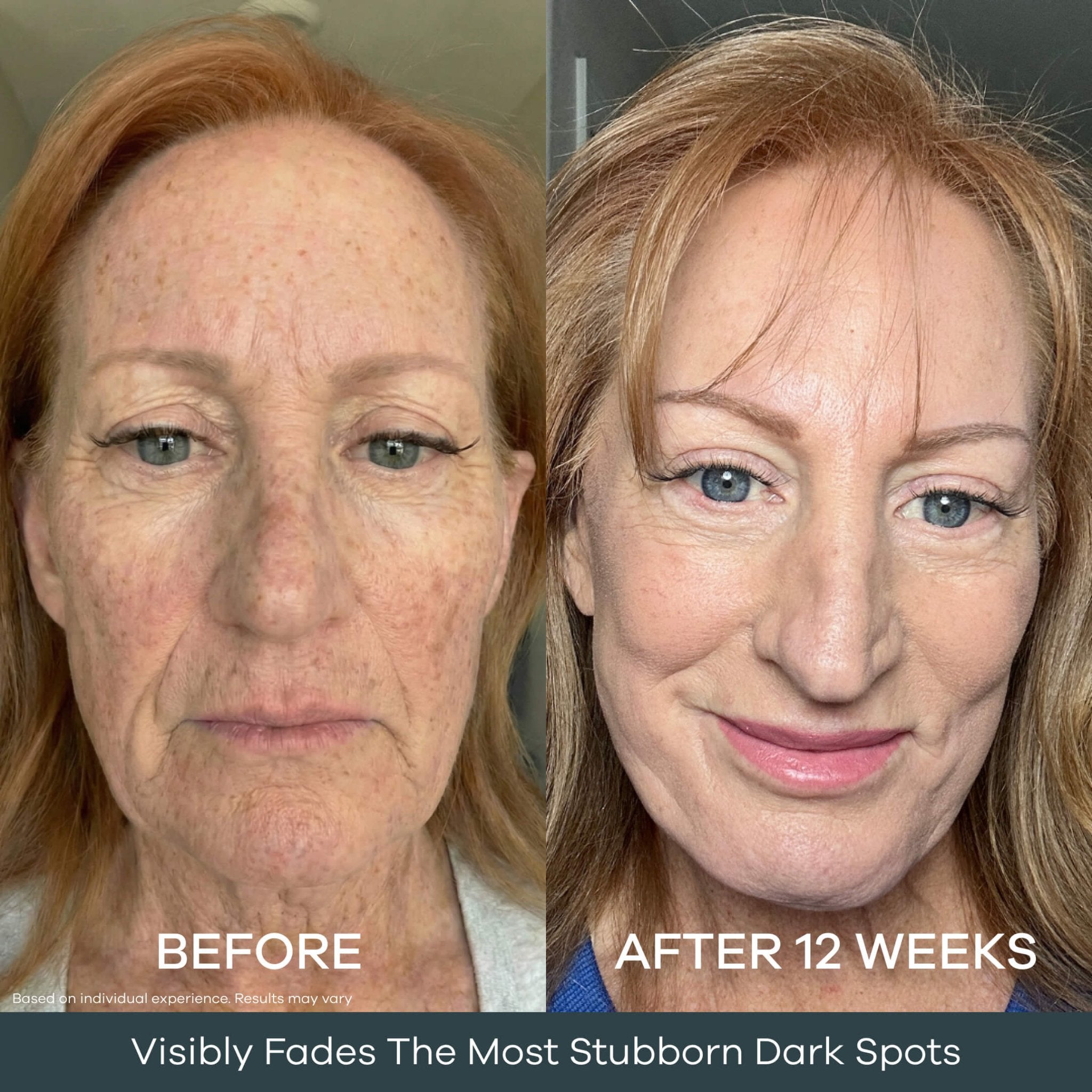 The Micro Infusion System Dark Spot System™ - Seranova