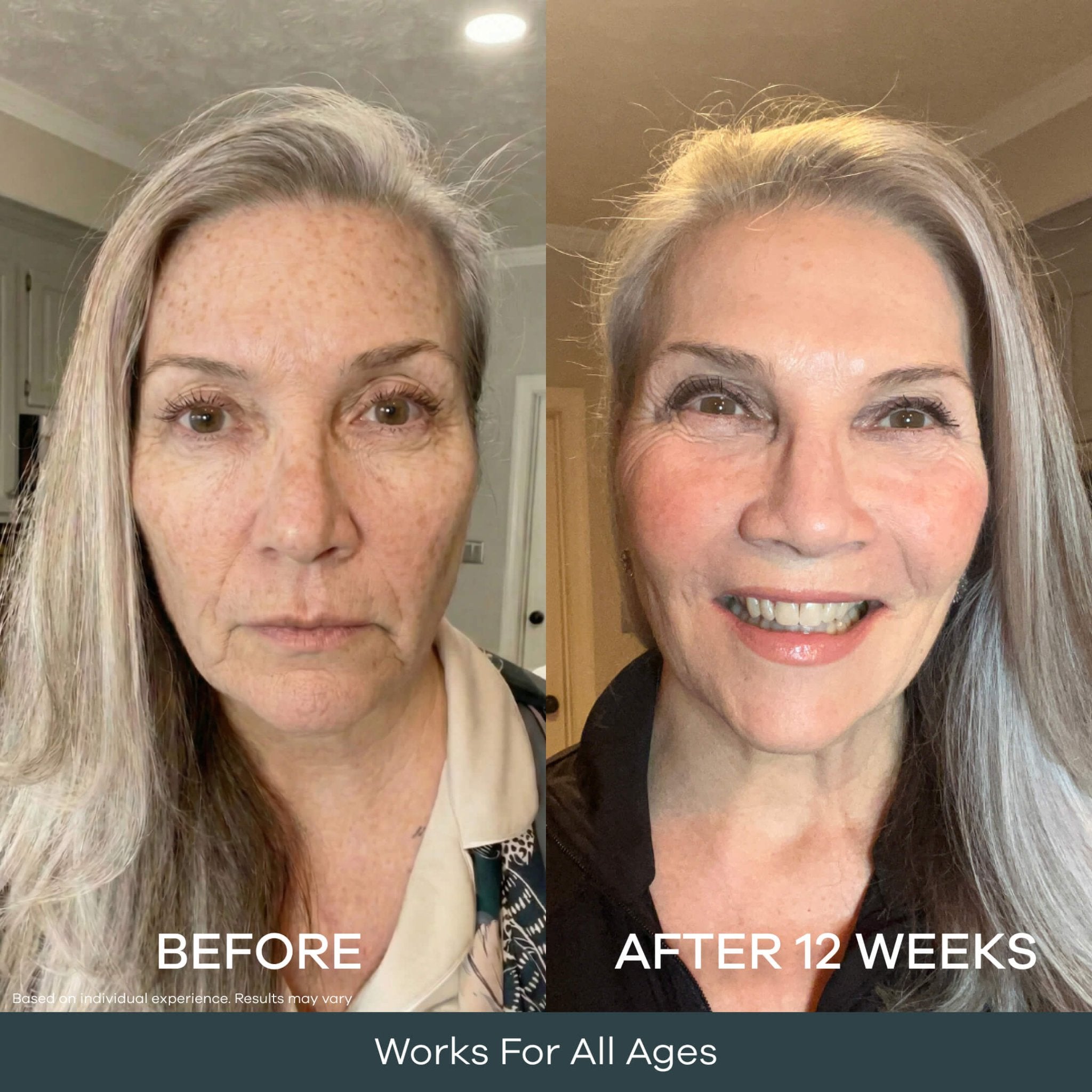 The Micro Infusion System Dark Spot System™ - Seranova