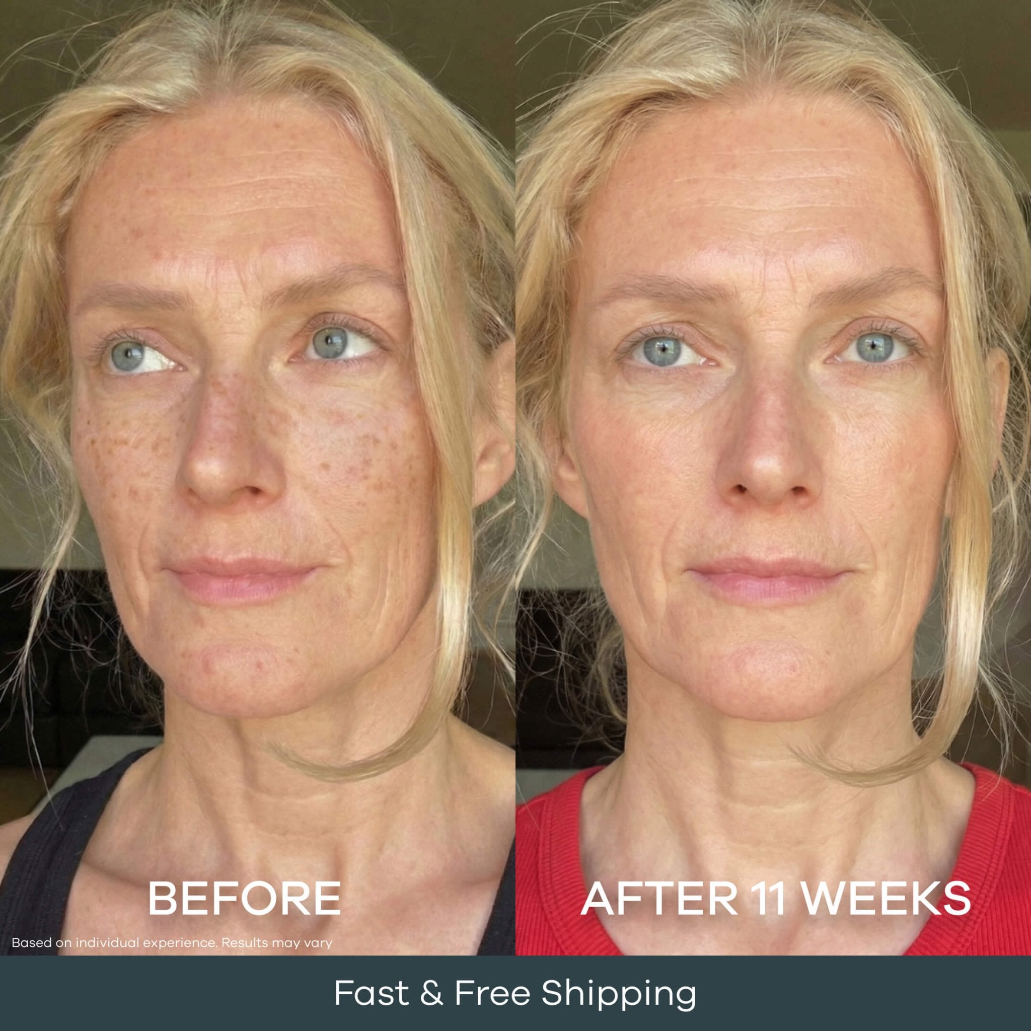 The Micro Infusion System Dark Spot System™ - Seranova