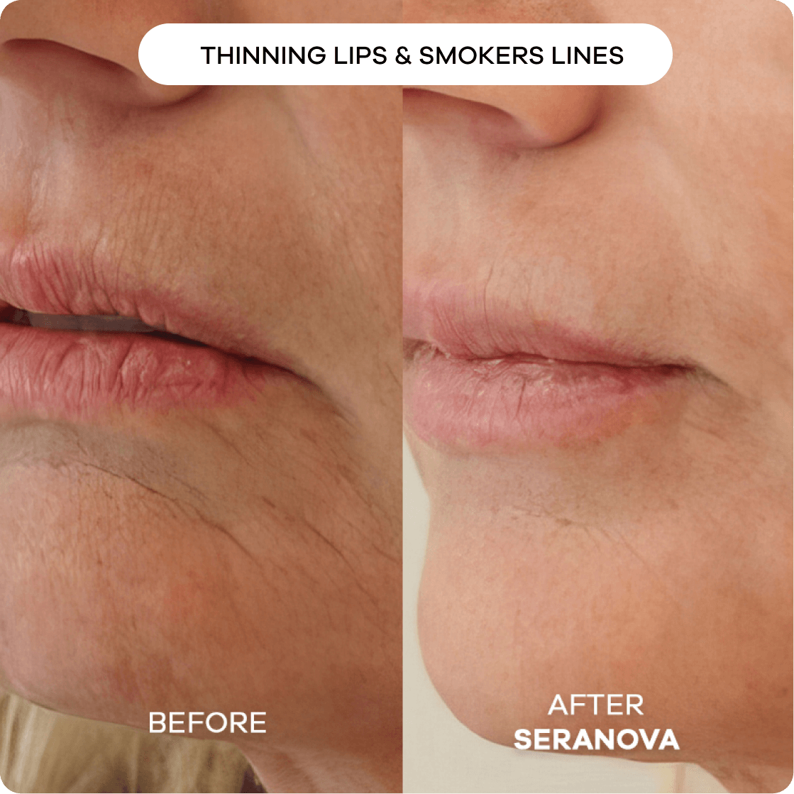 6 - Month Supply of The Microneedling Infusion System™ - Seranova