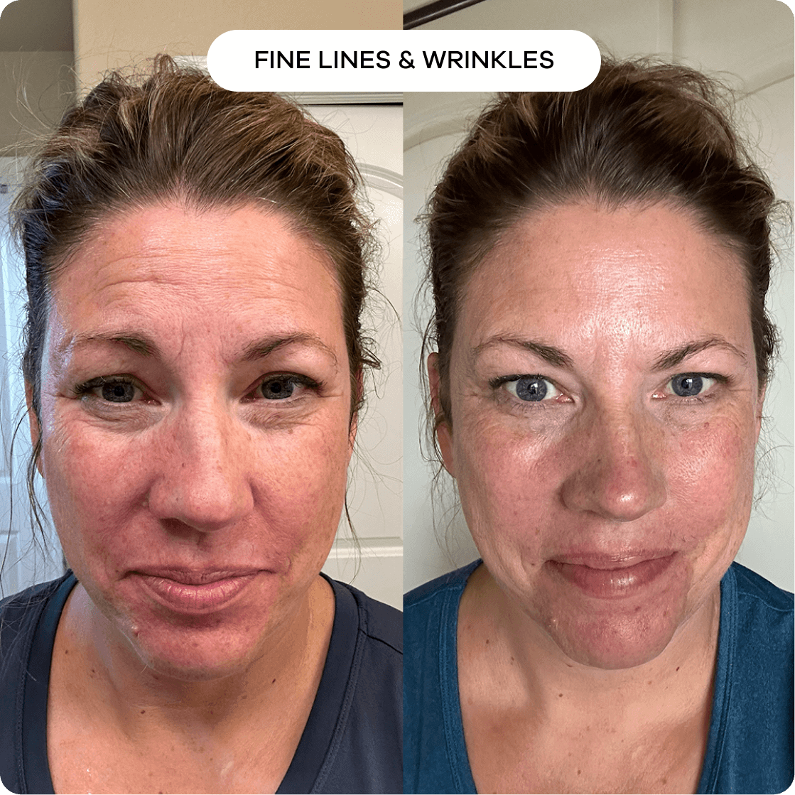 6 - Month Supply of The Microneedling Infusion System™ - Seranova