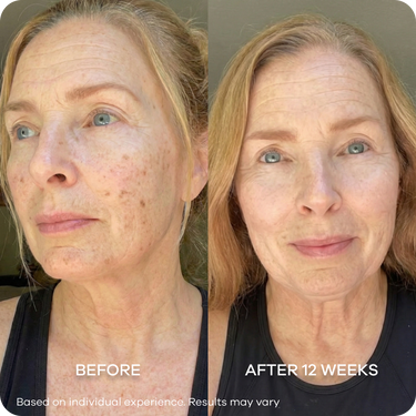 Post Inflammatory Hyperpigmentation