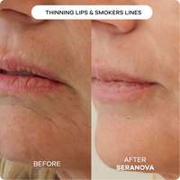 Microneedling Infusion System™