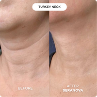 Microneedling Infusion System™