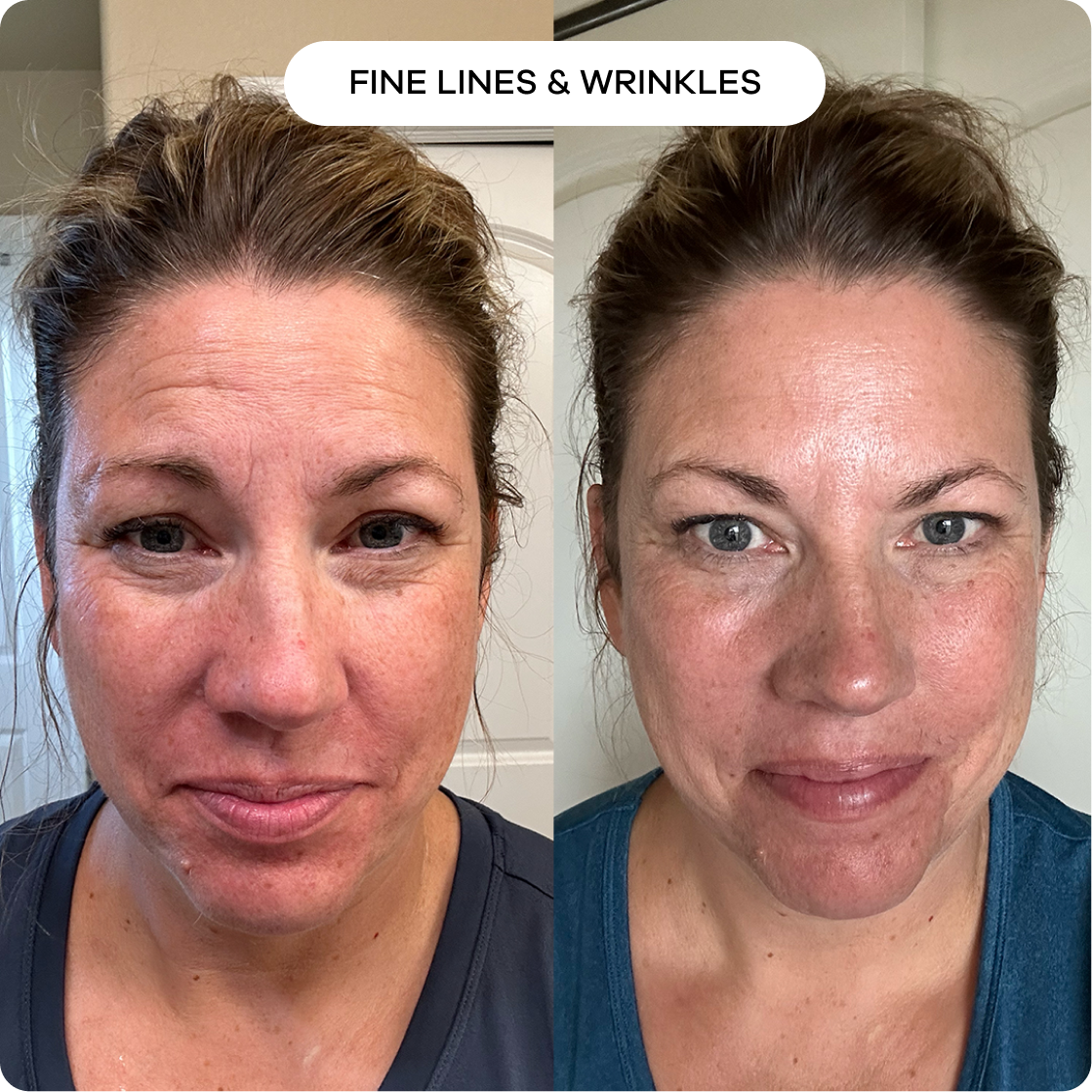 The Microneedling Infusion System™