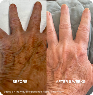 Dark Spots on Hands