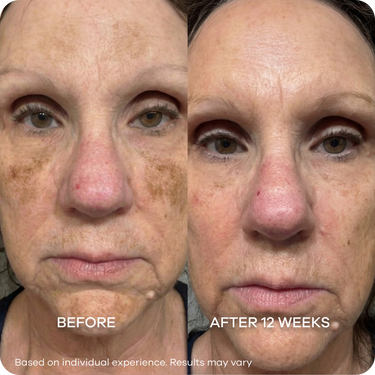 Melasma