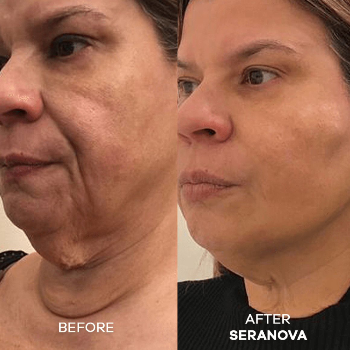 The Micro Infusion System™ - Seranova