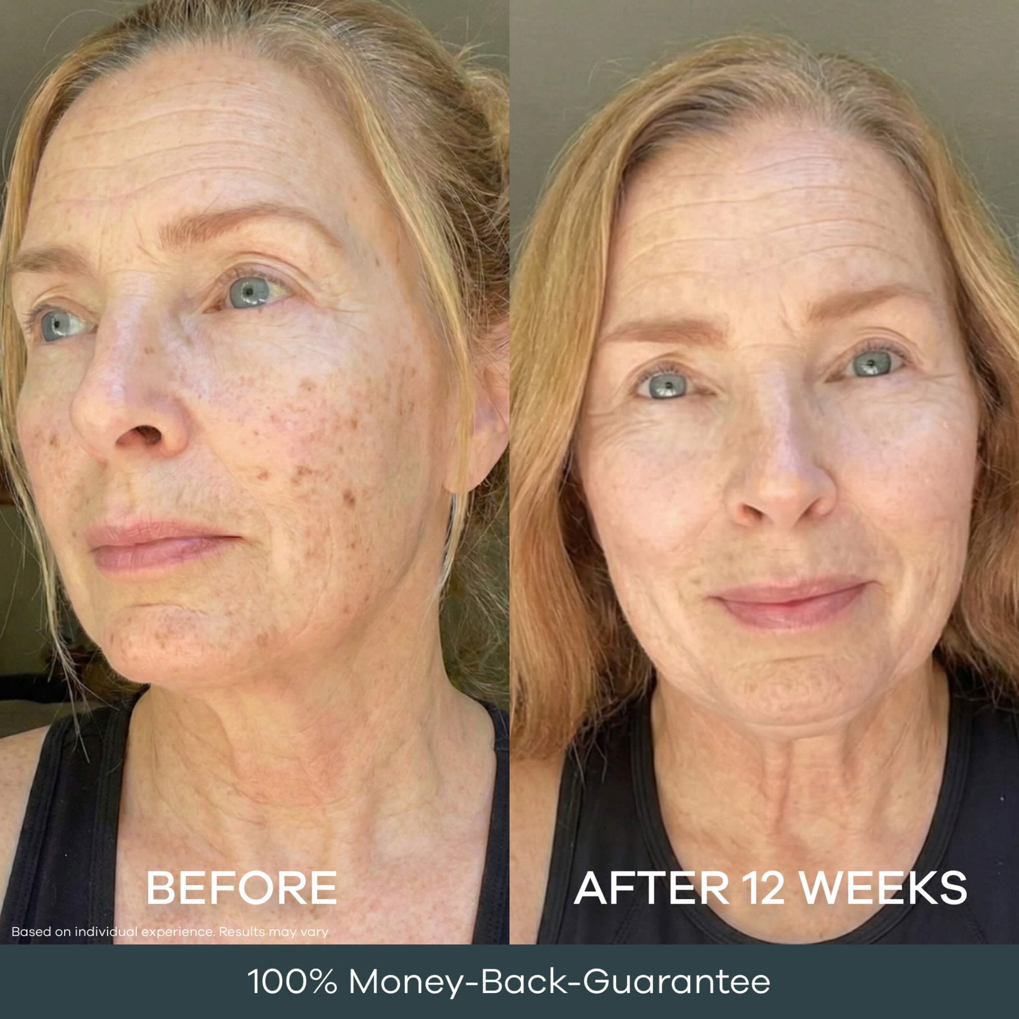 The Micro Infusion System Dark Spot System™ - Seranova