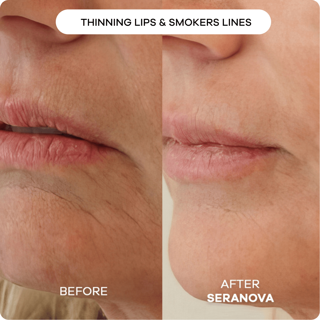 The Microneedling Infusion System™ - Seranova