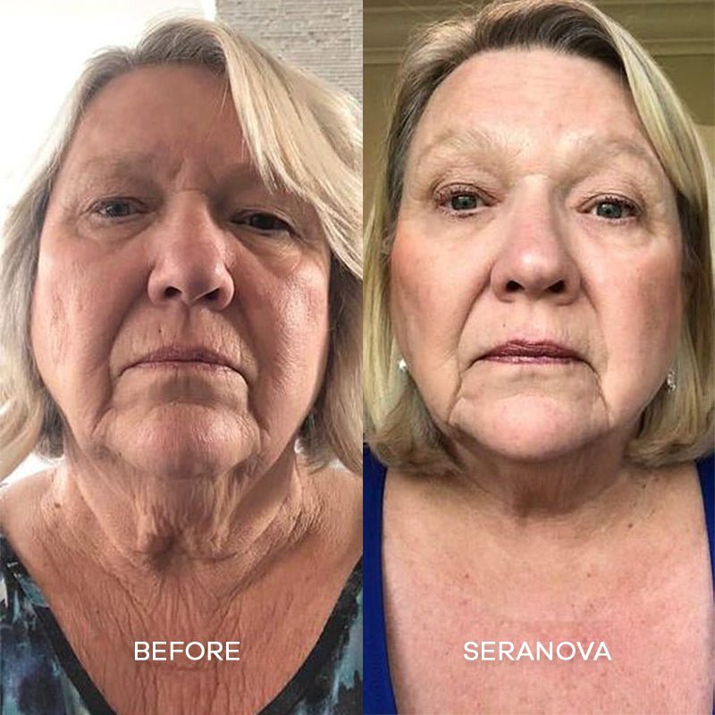 The Microneedling Infusion System™ - Seranova