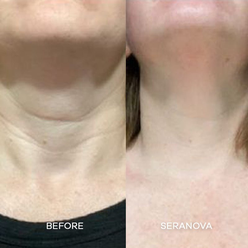 The Microneedling Infusion System™ - Seranova