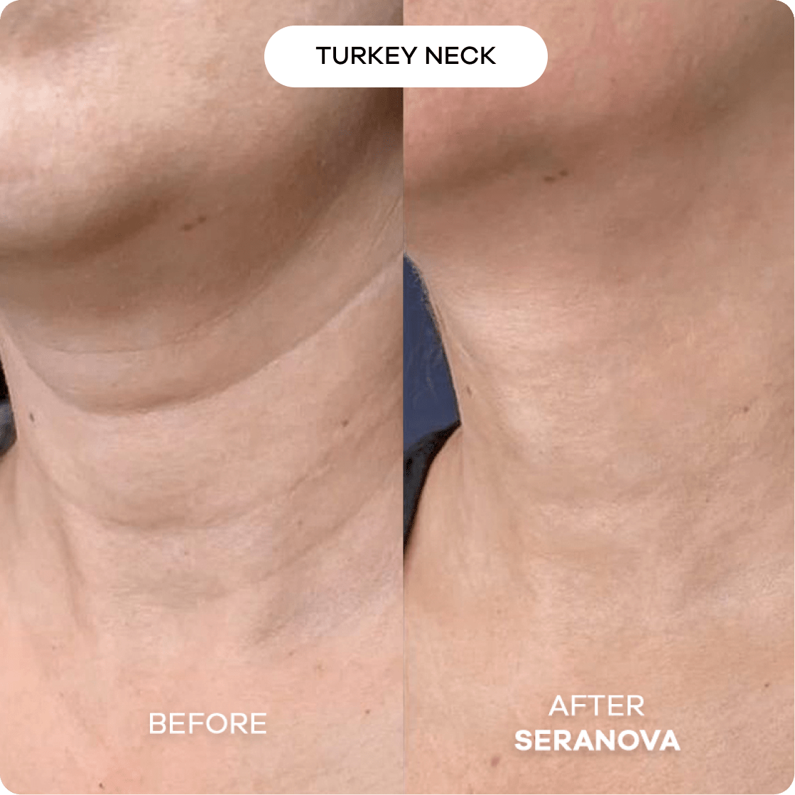 The Microneedling Infusion System™ - Seranova