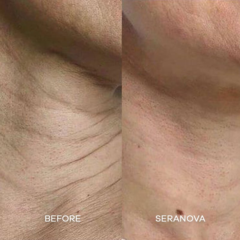 The Microneedling Infusion System™ - Seranova