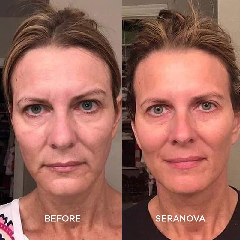 The Microneedling Infusion System™ - Seranova